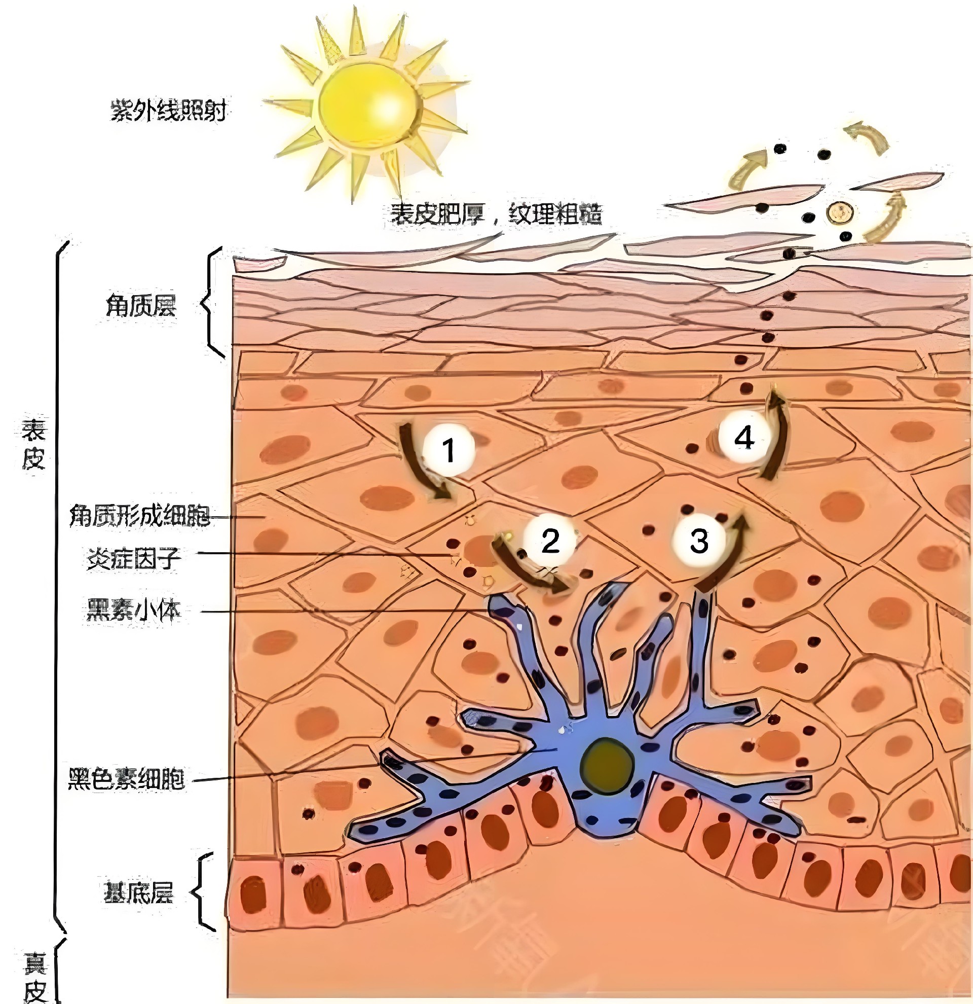 光照与皮肤炎症
